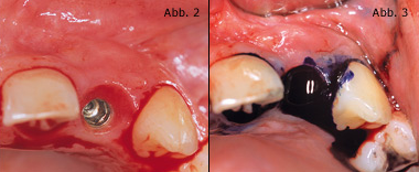 Initiale, minimalinvasive Therapie der Periimplantitis