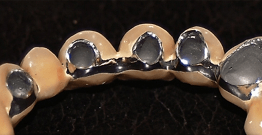 Spezielle Modellierungstechnik zur ­Erzielung sicherer Frontzahnästhetik