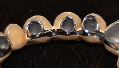 Spezielle Modellierungstechnik zur Erzielung sicherer Frontzahnästhetik