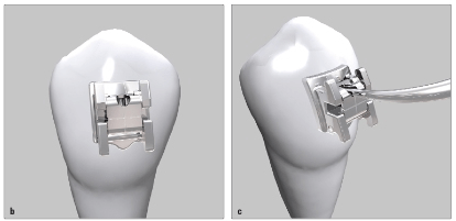 discovery® sl in MBT – ein erster Eindruck aus der Praxis