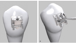 discovery® sl in MBT – ein erster Eindruck aus der Praxis