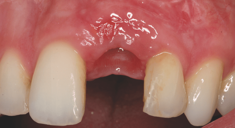 Frontzahnästhetik: Anspruch, Aufwand und Resultat