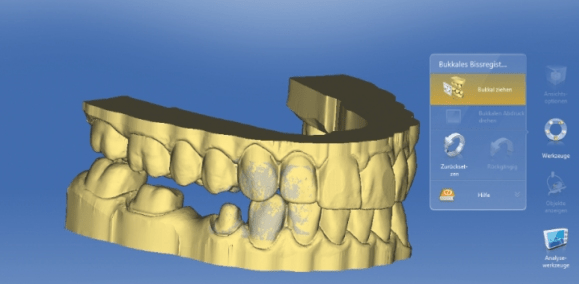 Ist die digitale Abformung wirklich präzise?