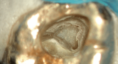 Endodontie beim älteren Patienten – Besonderheiten