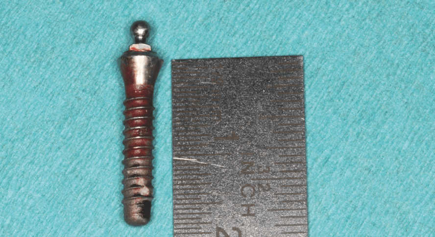 Die Entfernung eines Implantates mit dem Er:YAG-Laser