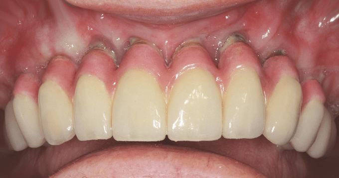 Periimplantitis – erfolgreich behandelbar?