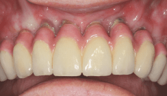 Periimplantitis – erfolgreich behandelbar?