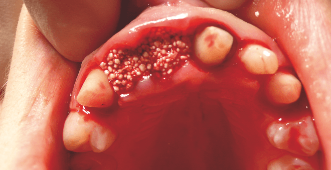 Individuelle Alveolarkamm­anatomie auf unkomplizierte Weise erhalten