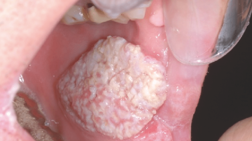 Den Tumor erkennen, bevor er entsteht!