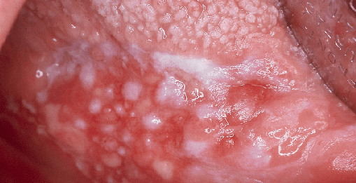 Die Leukoplakie der Mundschleimhaut