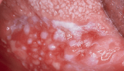 Die Leukoplakie der Mundschleimhaut