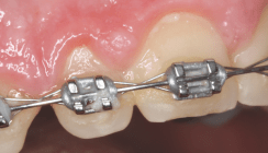 Zahnstellungskorrekturen mit Invisalign