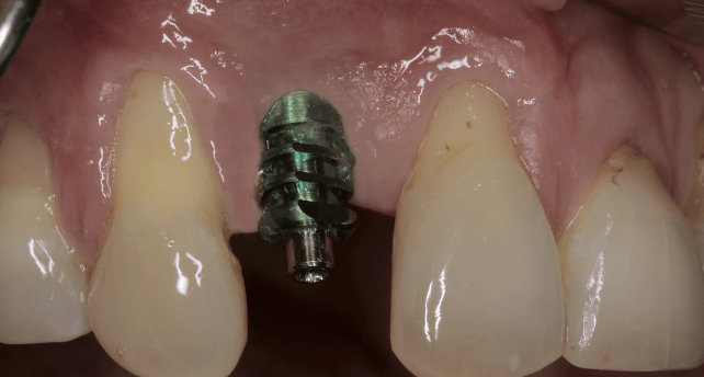Sofortimplantation und Weichgewebsmanagement bei bukkalem Knochendefekt