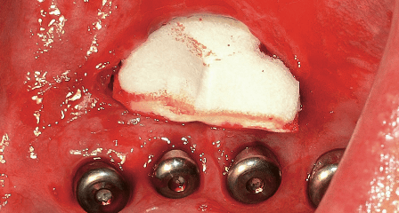 Vestibulumplastik unter Einsatz einer Kollagenmatrix