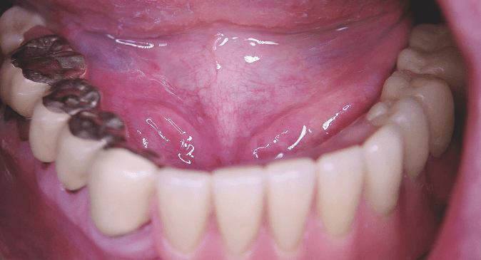 Herausnehmbar oder festsitzend?