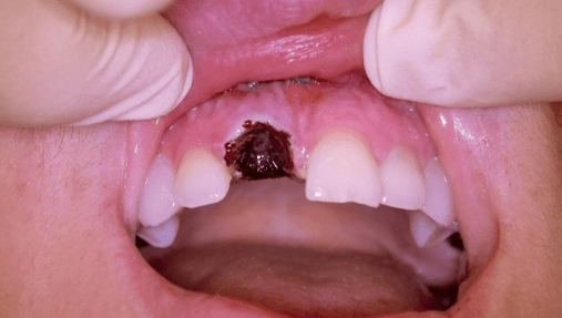 Laser Ridge Preservation