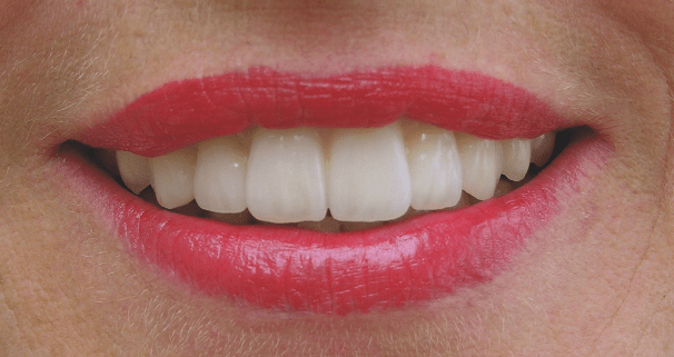 Ein individueller Behandlungsansatz bei Parodontitis