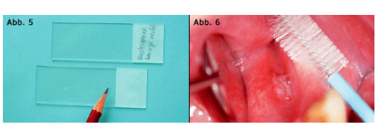 Mundkrebsfrüherkennung - eine tägliche Herausforderung