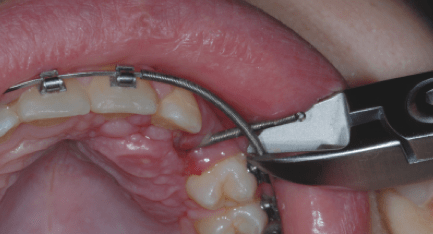 Zuverlässige Methode zur Einstellung verlagerter und retinierter Zähne