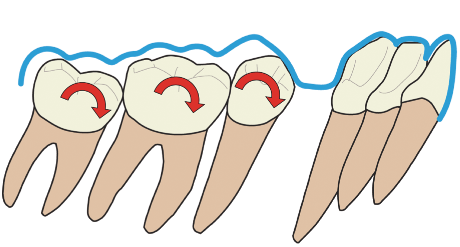 Angulationskontrolle bei Alignertherapie