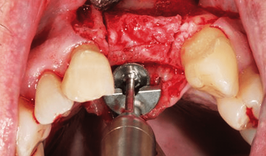 Erhöhung des Alveolarkammes mit Distraktionsosteogenese