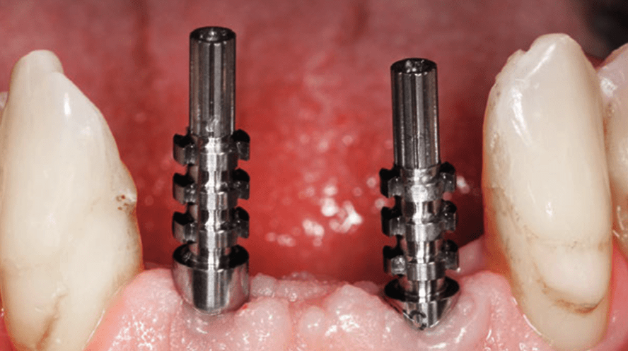 Sofortimplantation mit dem NNC-Implantat