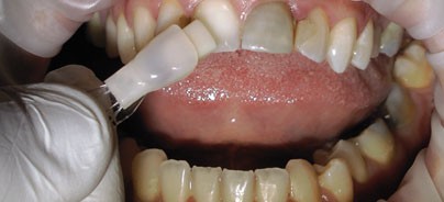 Nano-Composite-Veneers – Ein bioästhetischer Quantensprung