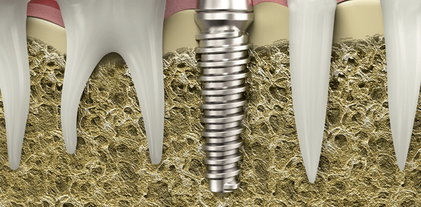 Bio-Hybrid-Implantat für perfekte Osseointegration