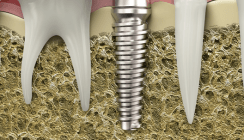 Bio-Hybrid-Implantat für perfekte Osseointegration