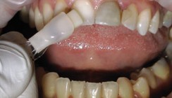 Nano-Composite-Veneers – Ein bioästhetischer Quantensprung