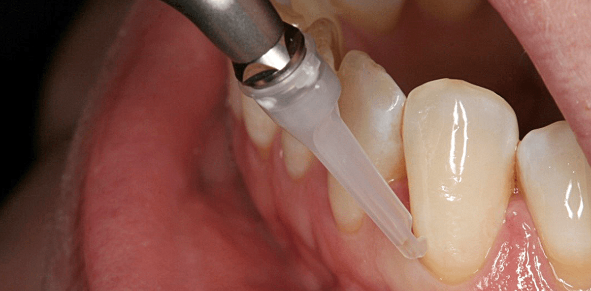 Air-Polishing – vom Power-Cleaning zum Biofilmmanagement