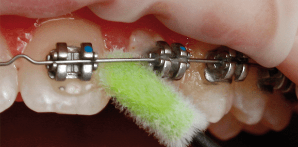 Biofilm-Management während der KFO-Behandlung