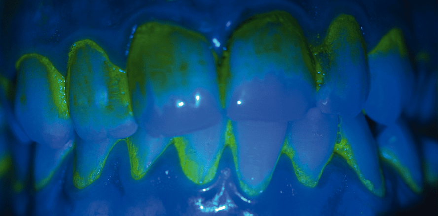 Gezielte Biofilmkontrolle bei periimplantärer Mukositis