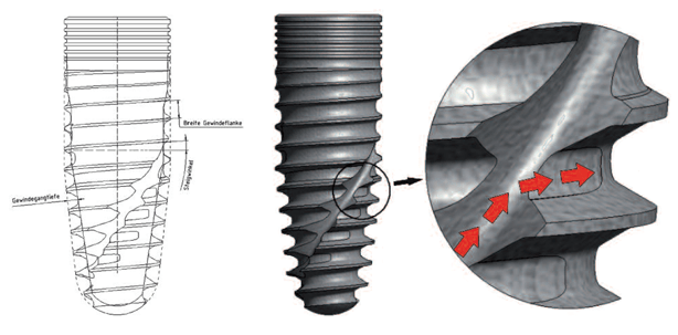 Bionische Anforderungen an das Implantatdesign moderner Systeme