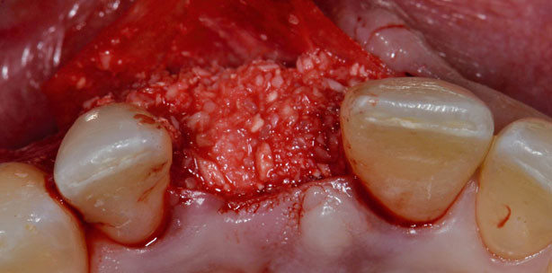 Biologisch zur knöchernen Augmentation