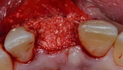 Biologisch zur knöchernen Augmentation