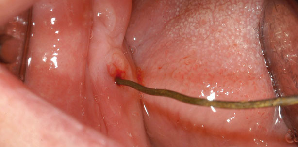 Update zu Bisphosphonat-assoziierten Kiefernekrosen