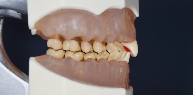 Minimalinvasive Bisshebung mit palatinalen Plateaus