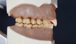 Minimalinvasive Bisshebung mit palatinalen Plateaus