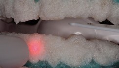 Bleaching – neue Wege einer minimalinvasiven Behandlung