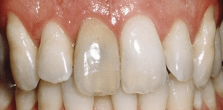 Bleaching devitaler Zähne – Zusatzleistung Endodontie