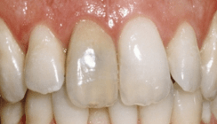 Bleaching devitaler Zähne – Zusatzleistung Endodontie