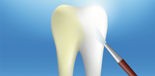 Achtung: Bleaching und die Umsatzsteuer