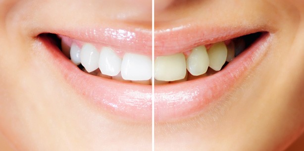Dentale Schönheit um jeden Preis!?