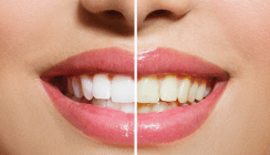 Weiß, weißer, Bleachorexia