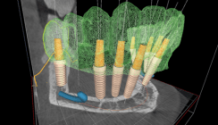 Navigierte minimalinvasive Implantationen für den zahnlosen Kiefer
