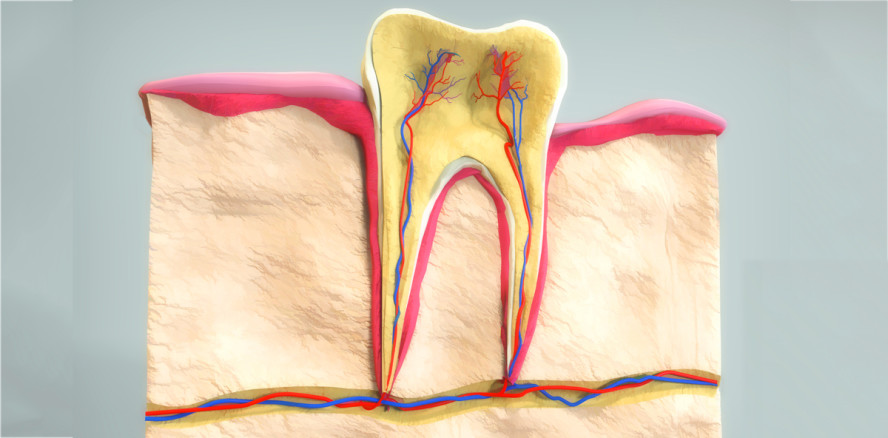 Therapie des Bone Remodeling parodontal lokal – Therapie des lokalen Knochenstoffwechsels