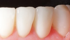 Full Mouth Rehab und Therapie des Gummy Smiles mit Botulinumtoxin