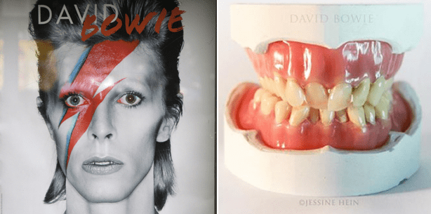 David Bowies Zähne nachmodelliert