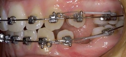 Vor- und Nachteile selbstlegierender Brackets
